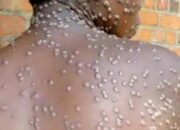 Jubir Kemenkes Sebut Seseorang yang Terinfeksi MPOX Tetap Butuh Pengobatan