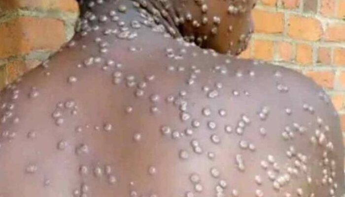 Jubir Kemenkes Sebut Seseorang yang Terinfeksi MPOX Tetap Butuh Pengobatan